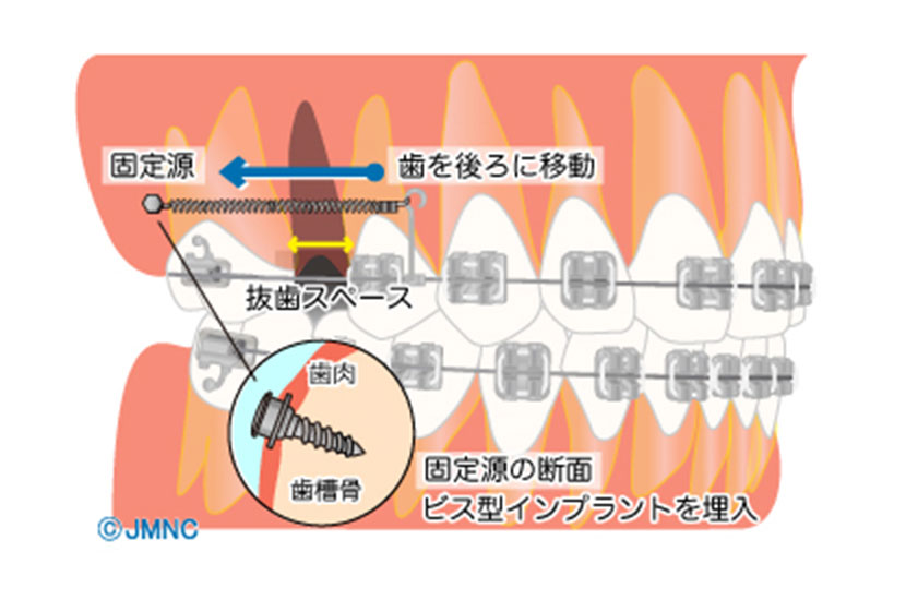 できるだけ歯を抜かないために『歯科矯正用アンカースクリューを用いた矯正治療』