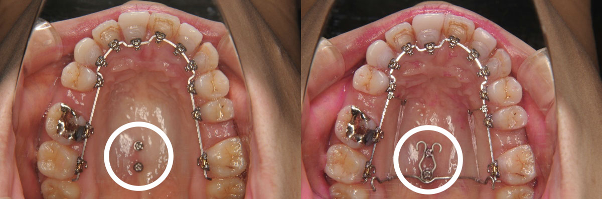 通常の矯正治療では困難な歯の移動も